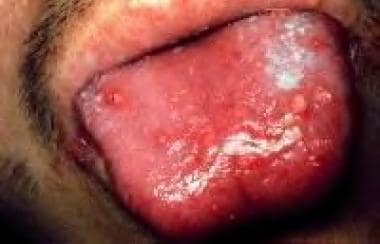 Herpetiform oral ulcer. 