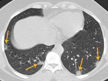Axial chest CT at lower level of the same patient 