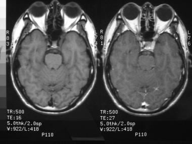 一个40岁男性的MRI，严重的Perioraital p