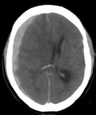 This 40-year-old woman was anticoagulated with war