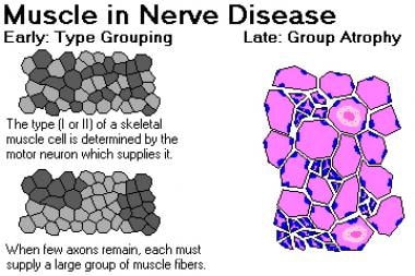 Muscle in nerve disease. Image courtesy of Dr. Fri