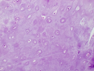 Enchondroma Pathology. Chondromas display large ar
