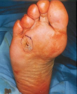 Lateral plantar foot ulceration, just proximal and