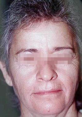 Laser tissue resurfacing. Female patient with skin