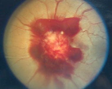 Left eye of a 28-year-old female with subarachnoid