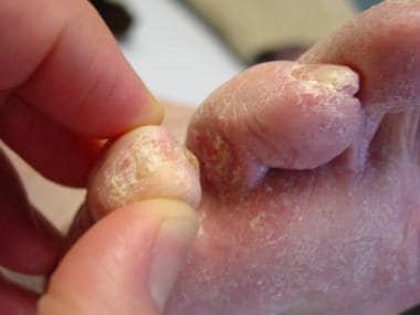 Fifth-toe deformities. Example of kissing corn. Th