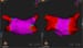 Atrial Fibrillation