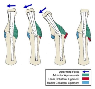 Displacement of the ulnar collateral ligament by t