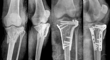 anterior tibial plateau fracture