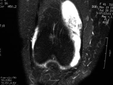 Coronal T2-weighted MRI of knee in patient with sy