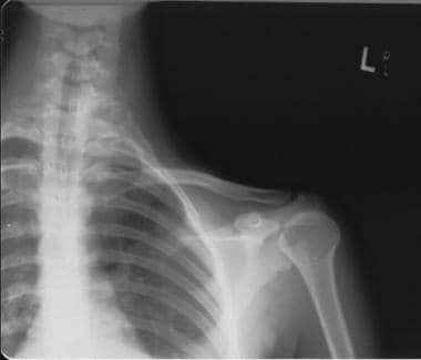 Radiograph of cervical spine reveals expansile les