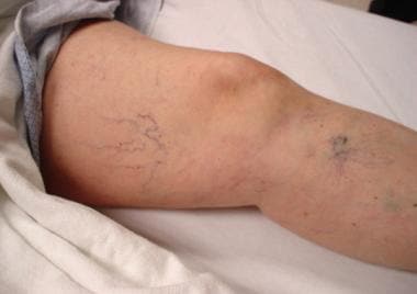 Using foam sclerotherapy to treat underlying vein conditions