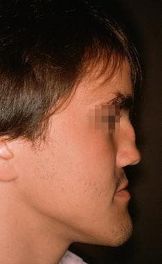 Proplast nasal grafts. A 20-year-old man with a po