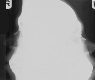 Lateral radiographic view of a minimally displaced