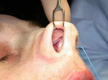Basic closed technique for rhinoplasty. Endonasal 