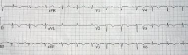 Takotsubo (stress) cardiomyopathy (broken heart sy