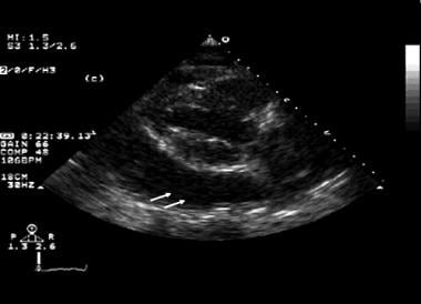 This echocardiogram shows a large amount of perica