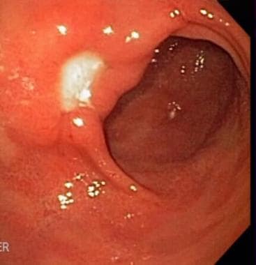Peptic ulcer disease. Gastric ulcer (lesser curvat