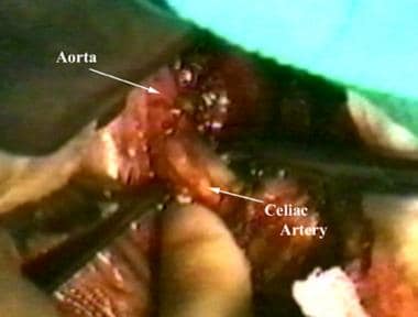Celiac artery is exposed at its origin in preparat