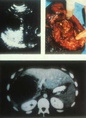 Ultrasonographic, CT scan, and perioperative aspec