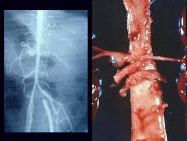 Childhood polyarteritis nodosa. Multiple aneurysms