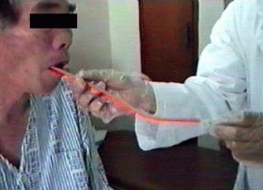 Oroesophageal tube feeding can be used by patients