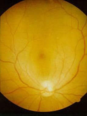 Funduscopic examination of the right eye of a pati