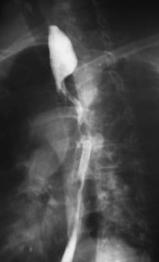 Esophageal cancer. Barium swallow demonstrating st