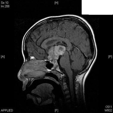 MRI of the brain - T1-weighted image - post-gadoli