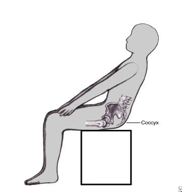 Coccyx Pain: Practice Essentials, Anatomy, Etiology