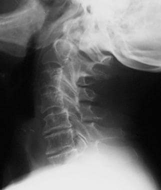 Rheumatoid arthritis. Lateral view of the cervical