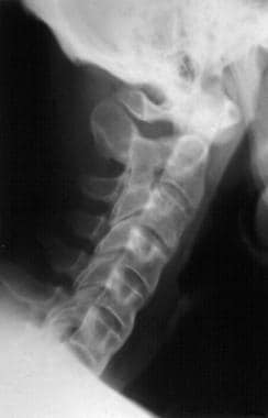 This radiograph of the cervical spine of a patient