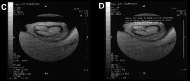 Precontrast MRI of the penis in the axial plane (T