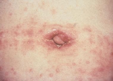 Candidiasis. Image courtesy of Hon Pak, MD. 