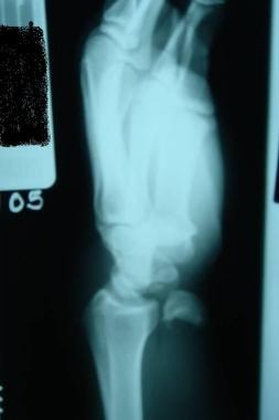 Dislocations, wrist. Lateral view of a lunate disl