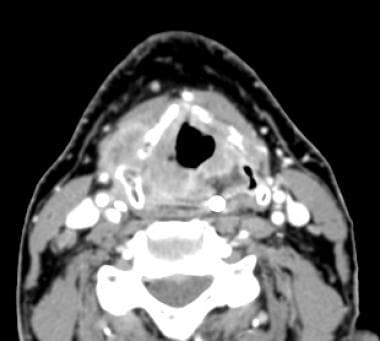 Axial view on CT scan of an advanced right larynge