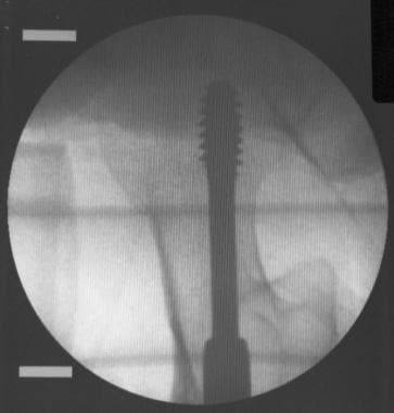Intraoperative x-ray film (fluoroscopic view) of p