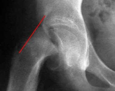 epiphysis of neck of femur