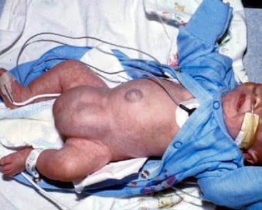 A premature baby boy with bilateral giant inguinos