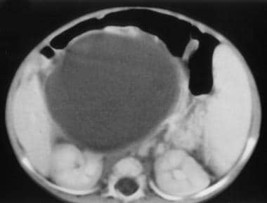 CT scan shows a large cyst with wall thickening. 