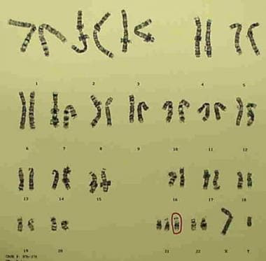 down syndrome karyotype