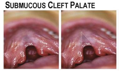 Submucous cleft palate. 