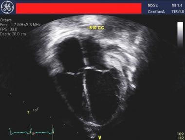 Four-chamber echocardiographic view following emer
