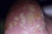 Pustular Psoriasis