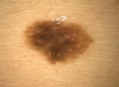 Dark-brown pigment network in a melanocytic nevus.