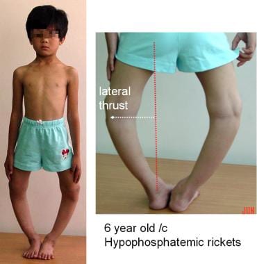 Bowed Legs - Kids Plus Pediatrics