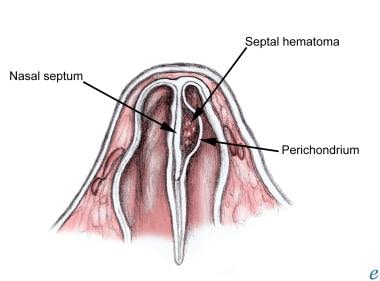 nazal septal hematom