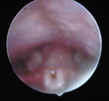 Omega-shaped epiglottis in 30-day-old male patient