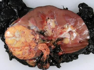 RENAL CELL CARCINOMA- CLEAR CELL TYPE - Pathology Made Simple