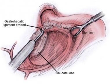 Laparoscopic Nissen Fundoplication Technique: Laparoscopic Nissen